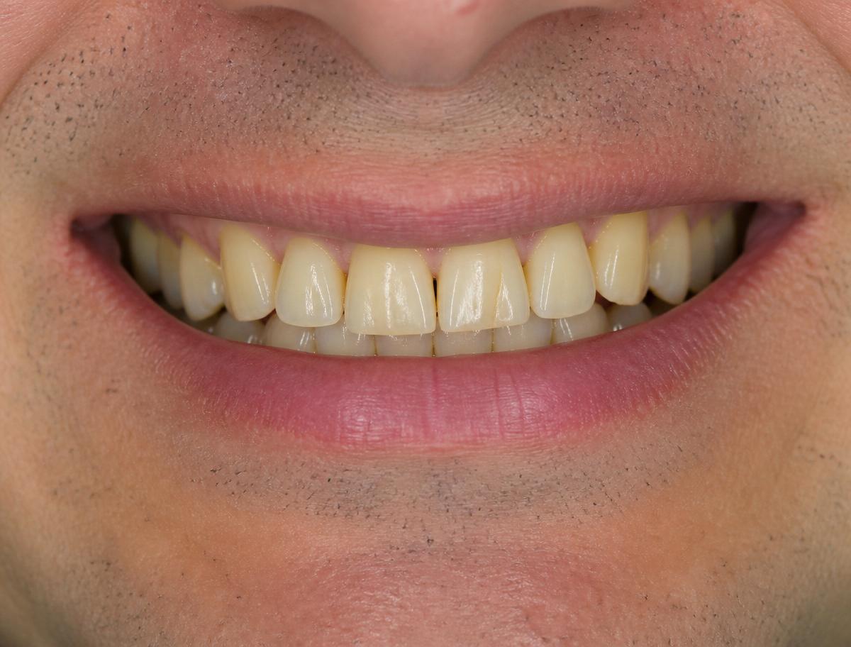 Sorriso antes das lentes de contato dental